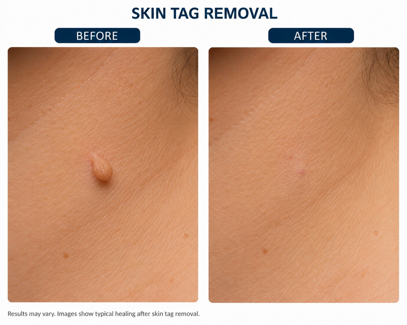 Illustration showing a skin tag before treatment and the same area after removal showing typical healing