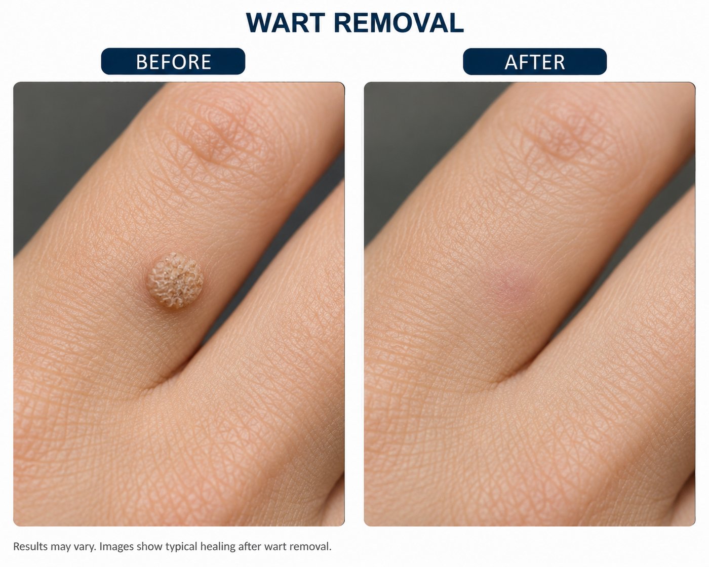 Illustration showing a wart on a finger before treatment and the same finger after removal showing typical healing